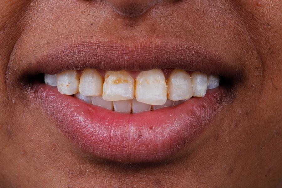Sorriso antes do tratamento, caso 1