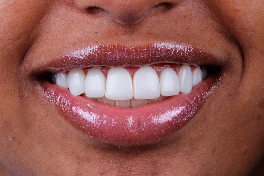 Sorriso depois do tratamento, caso 1