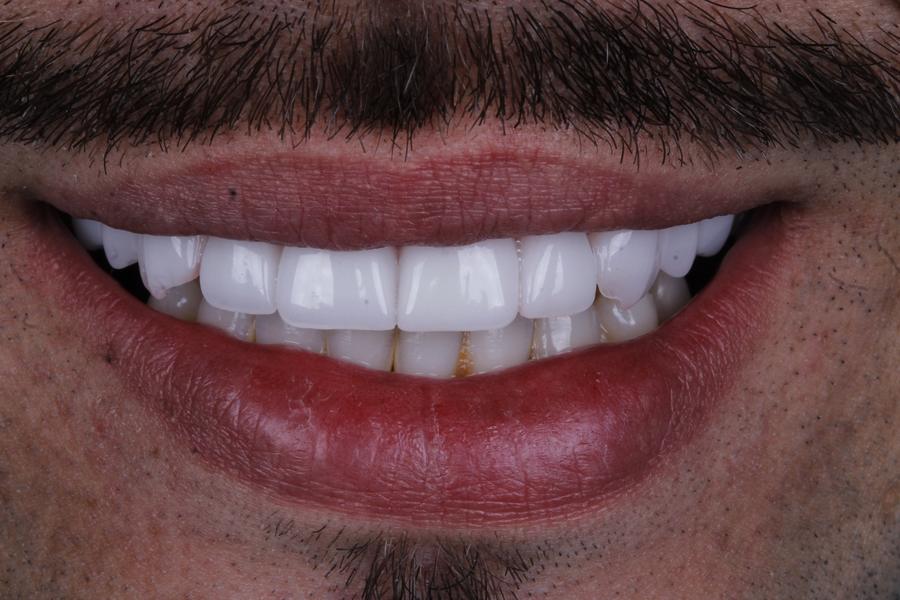 Sorriso depois do tratamento, caso 2