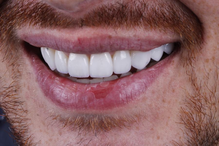Sorriso depois do tratamento, caso 3