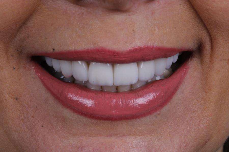Sorriso depois do tratamento, caso 4