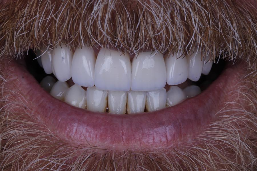 Sorriso depois do tratamento, caso 5
