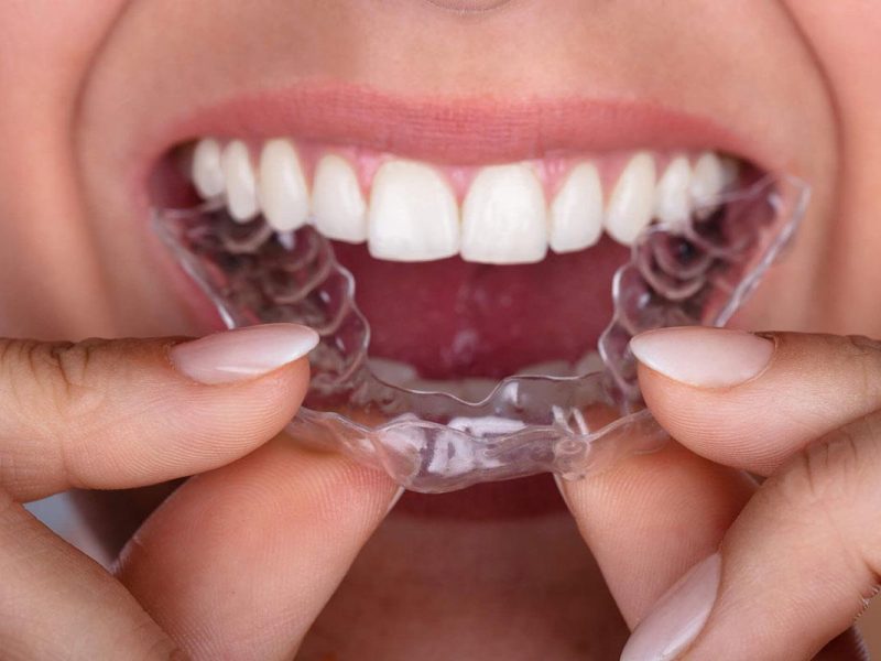 invisalign invisalign